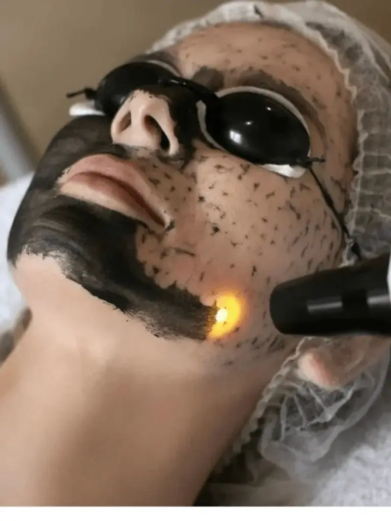 Hollywood Peel